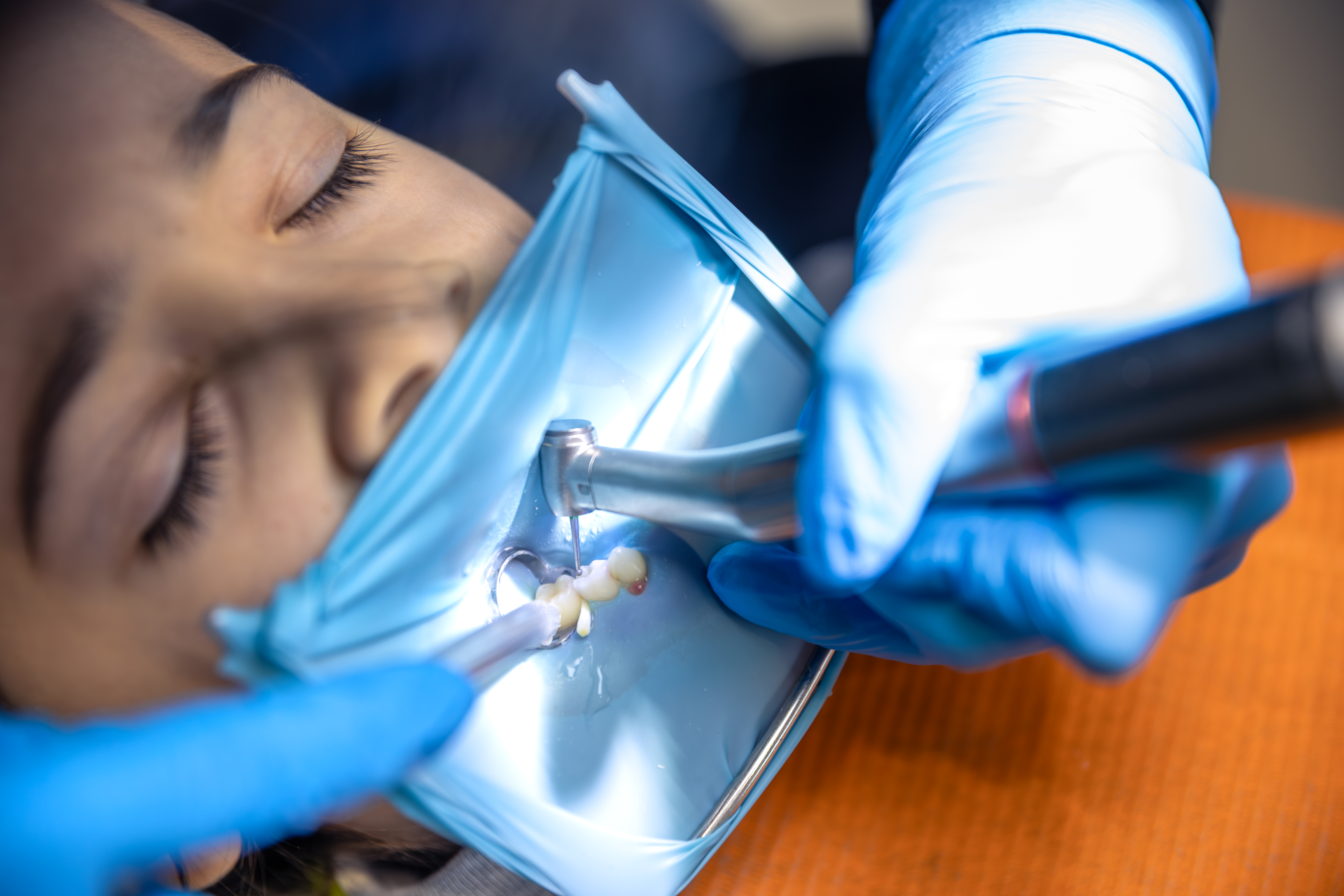 Stress-Free Fillings with Rubber Dam & Biomimetic Restorations in Kerala